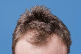 Thin hair (or sparse hair) means that there are fewer follicles on the head, and, if it's not fixed properly, the scalp can be seen in some places. 6 Common Hair Loss Causes In Men Man Of Many
