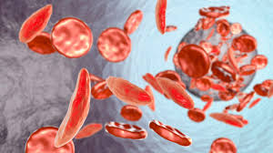 Image result for Anemia
