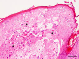 Find details on cat pox disease in cats including diagnosis and symptoms, pathogenesis, prevention, treatment, prognosis and more. Atypical Cowpox Virus Infection In A Series Of Cats Sciencedirect