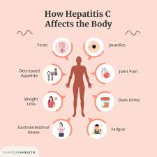 Image result for hepatitis symptoms