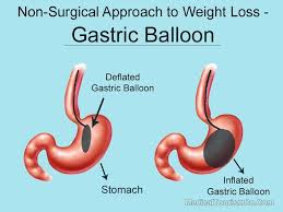 gastric balloon in cancun mexico