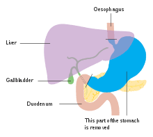 We've put some small files called cookies on your device to make our site work. Stomach Cancer Wikipedia