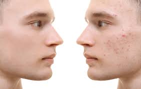 Taking a warm bath before applying the packs will help in opening up pores. Laser Hair Removal For Teens And Kids Spoiled Laser 702 228 5171