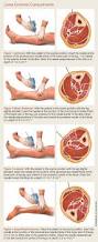 Image result for Compartment Syndrome