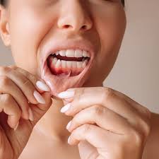Gum Disease Treatment