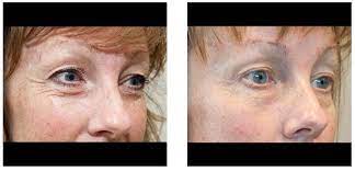 Ameliyatsiz Saten Yuz Germe Uygulamasinda Goz Cevresi Calismasi Ile Yuz Gulduren Sonuclar Yuzler Gozler Uygulamalar