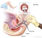 Definition of Pap smear - NCI Dictionary of Cancer Terms - NCI