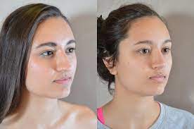 Maybe you would like to learn more about one of these? Society Nose Best Or Do You My Rhinoplasty Sonia Begonia