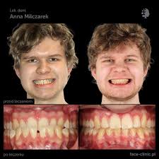Pan Bartosz zgłosił się do nas z powodu wady szkieletowej klasy III  (przodozgryz) oraz nieprawidłowości zębowych. Plan leczenia obejmował  leczenie ortodontyczno-chirurgiczne oraz periodontologiczne W etapie  przygotowawczym zastosowano dwa aparaty ...
