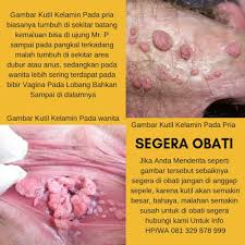 Sebagai masyarakat indonesia, cabe secara umum bisa dikatakan sebagai salah satu bahan dasar masakan nusantara. Cara Merawat Ketuat Kelamin Dengan Cepat Ubatketuatkelamin