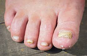 Petele albe pe unghiile copilului dispar treptat atunci când începe să primească substanțele nutritive necesare. Onicomicoza Infectia Cu Ciuperci A Unghiei Newsmed Ro