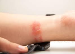 Image result for Intertrigo