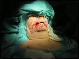 An old flap for reconstruction of lower lip defects due to lower lip carcinoma resection. Total Lower Lip Reconstruction By Bilateral Fujimori Technique A Case Report Abstract Europe Pmc