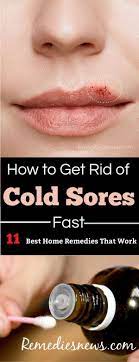 How To Get Rid Of Cold Sores Fast 11 Best Home Remedies Cold Sore Treatment Cold Sore Cold Home Remedies