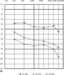 age related typical audiogram demonstrating the progression