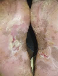 From least to most common. Erosive Lichen Planus Of The Soles Effective Response To Prednisone Springerlink