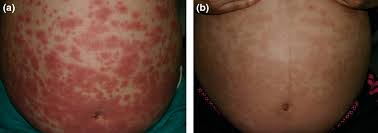 Image result for pruritic urticarial papules and plaques of pregnancy
