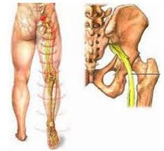 Sciatica Pain Treatment Tam Duc Tmc Acupuncture In Saigon