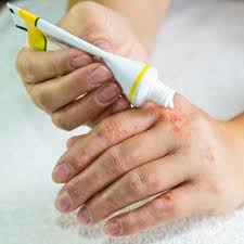 Nov 29, 2017 · on estime que 30 à 40 % des kystes du poignet s'estompent spontanément au bout des 4 premiers mois, rappelle le dr frédérique mazodier. Dysidrose Symptomes Et Traitement Doctissimo