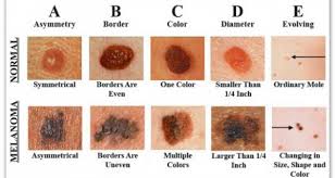 Other tumors we see more rarely in children are leukemia (a blood cancer) and a tumor called teratoma that often appears as a mass near the coccyx bone. Skin Cancer Part 3 Of 3 Check Your Skin Wellness Advice And Prayers From The Road