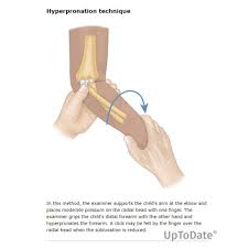 Image result for Radial Head Dislocation