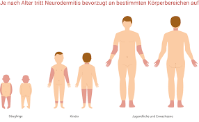 Pityriasis alba on the cheek. Neurodermitis Hilfe Pflegetipps Behandlung Ernahrung Wolfs Apotheke Bredstedt