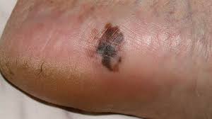 You are also at risk is you have overexposure to uva or uvb rays, ionizing radiation, chemical carcinogens, and arsenic. Foot Melanoma Symptoms Causes And Treatments