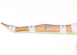 Image result for Long Arm Splint