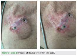 Image result for Cardiac Pacemaker Infection
