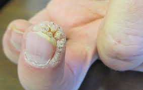 Maybe you would like to learn more about one of these? Periungual Warts Consultant360