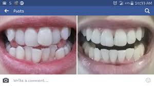 I'm really impressed with my treatment. My Journey With Smile Direct Club And Crooked Teeth Review