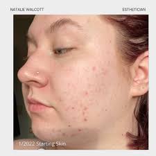 Natalie Walcott Esthetics (@nwalcottskin) • Instagram photos and videos