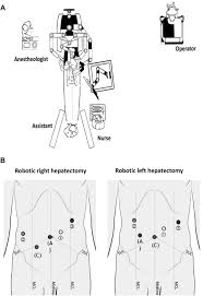 Liver resection is surgery to remove an area of your liver. Robotic Assisted Minimally Invasive Liver Resection Wu Et Al 2014b Scipedia