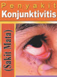 Check spelling or type a new query. Konjunktivitis