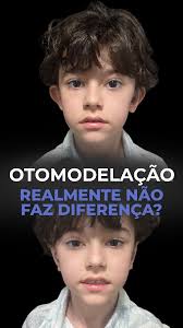 Orelha de abano realmente muda a aparência? Olha essa análise aqui do  jogador Gareth Bale.