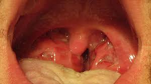 Image result for Strep throat infection roof of mouth