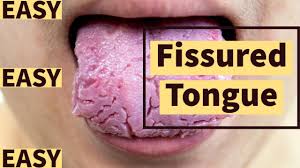 Image result for Fissured tongue