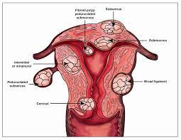 Dalam kebanyakan kes, wanita dengan ketumbuhan fibroid tidak menyedari bahawa mereka memilikinya, mungkin kerana saiznya terlalu kecil sehinggalah ia menyebabkan komplikasi yang ketara. Fibroid Blog Fertiliti Dr Natasha Nor