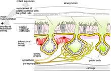 Rhinitis Wikipedia