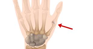Sprained Thumb - Symptoms, Causes, Treatment & Taping