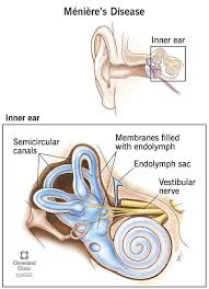 Image result for Inner Ear Decompression Sickness