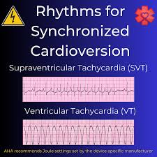 Image result for Synchronized Cardioversion