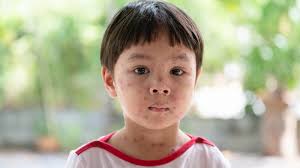 Image result for shingles in children