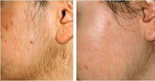 Best Laser Hair Removal Tips And Reviews Part 6 Laser Hair Removal Results Ipl Hair Removal Laser Hair Removal