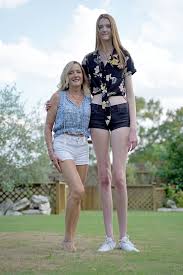 31 inspiring weight loss transformations. Teen With Record Breaking Long Legs Urges People To Embrace Differences Uklevitrasupport Com