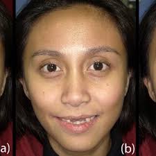PDF) Chairside and Labside CAD/CAM Workflow for Esthetic and Functional  Smile Design Rehabilitation
