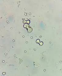 Calcium Oxalate Dumble Shape Medical Laboratory Scientist Microbiology Lab Medical Laboratory