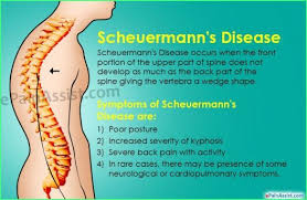 Pin On Kyphosis Treatment