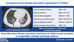 Image result for Connective Tissue Disorder