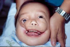 Поиск мутаций в гене tcof1, м. Rare Diseases In Pediatric Anesthesia